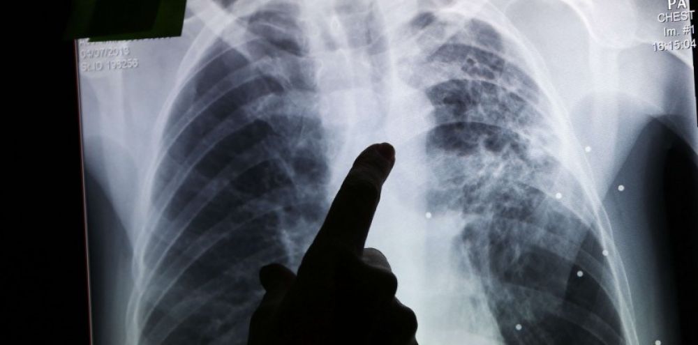 Tuberculose : 364 patients au Mali