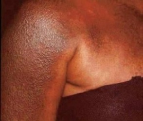 Dépigmentation : Une pratique qui se développe en Afrique