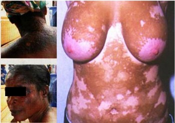 Phénomène de société : Les produits éclaircissants, une contradiction africaine