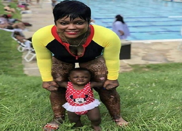 Acte monstrueux : Il met le feu à sa femme enceinte de 7 mois