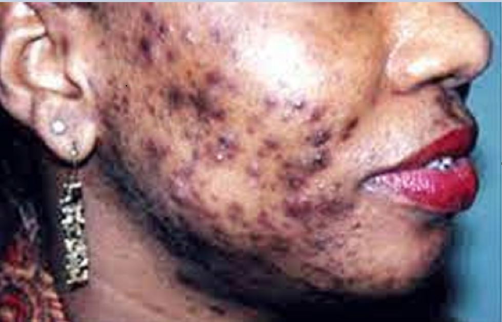 Le goût à la dépigmentation:  La quête à la beauté au péril de sa vie!