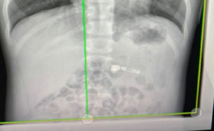 Un enfant de 7 ans avale l'écouteur AirPod d’Apple reçu à Noël